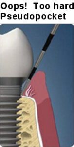 Dental implant hygiene probing