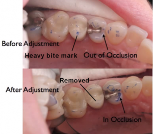 Dental implant occlusion