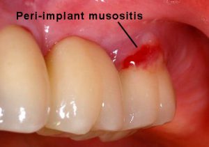 Peri-implant mucositis